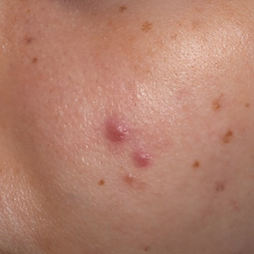 Home acne
